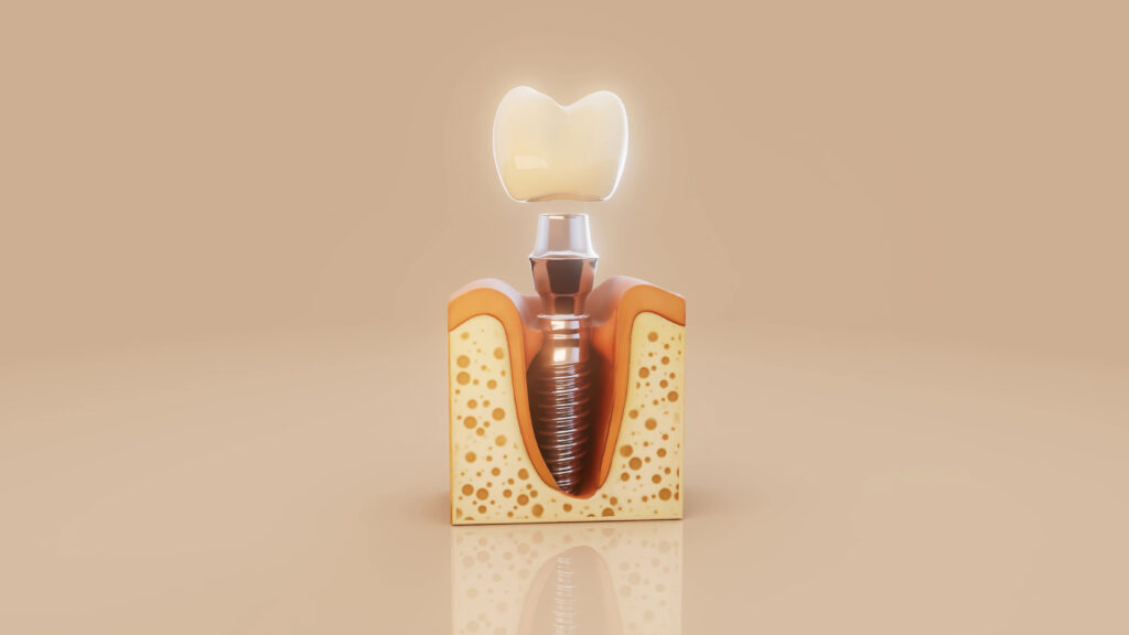 Dental Implant Procedure