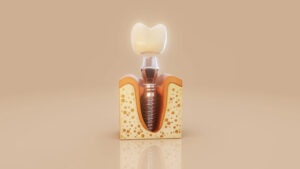 Dental Implant Procedure