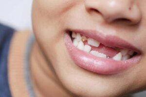 missing tooth